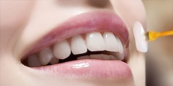 Lente de Contato Dental